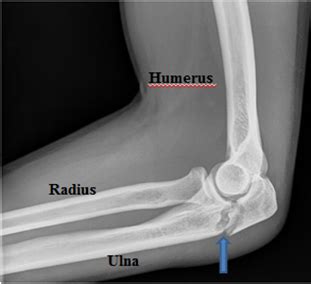 Elbow Fractures