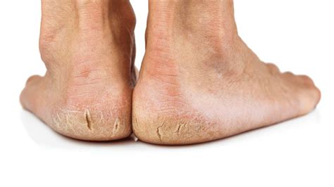 cracked heels  symptoms treatment  feet people podiatry