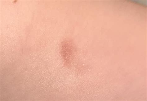 dry patch  skin     rdermatology