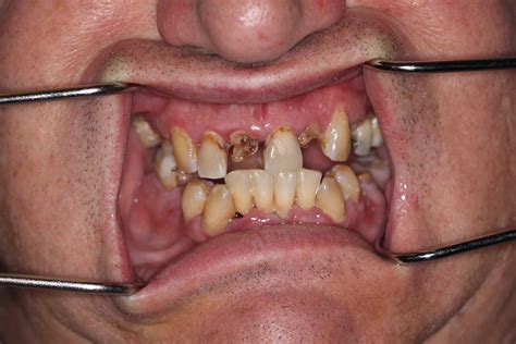 teeth removed     oral facial surgical arts pa