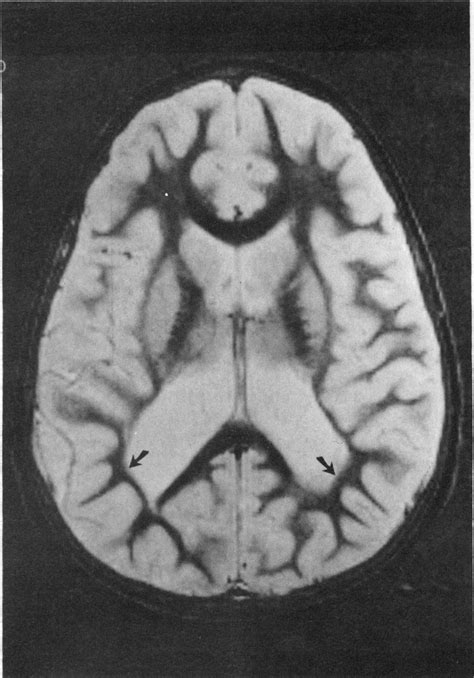 Spastic diplegia - Pandora's Box of Pathologies