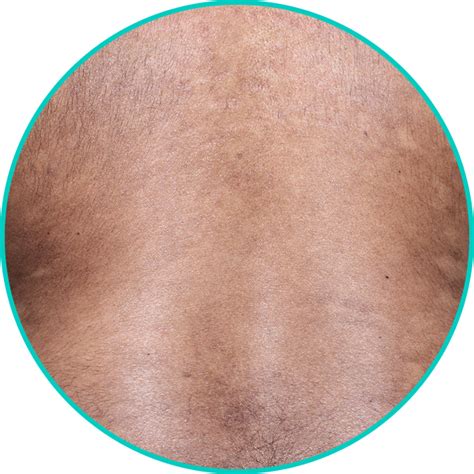 VISIBLE: Moderate to Severe Plaque Psoriasis Skin Results | TREMFYA ...