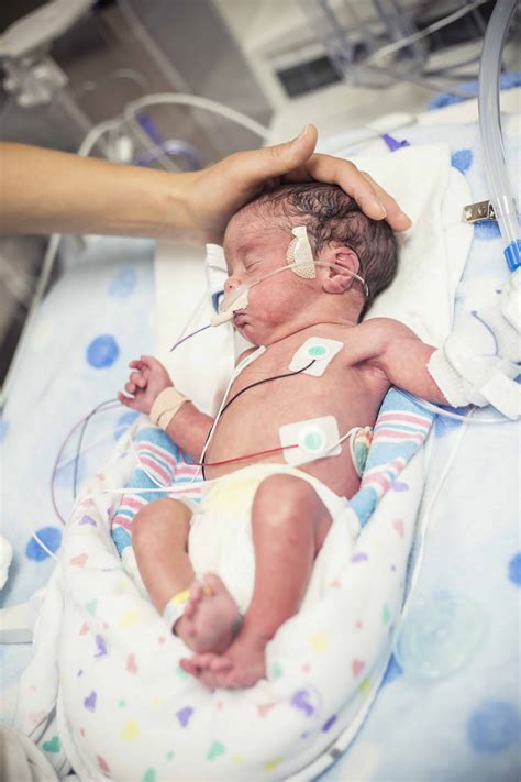 Newborn premature baby in the NICU intensive care | ABD