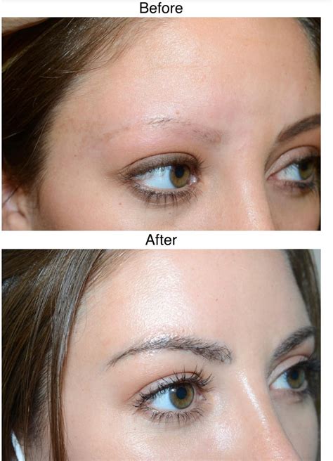 eyebrow hair transplants harley street hair transplants manchester
