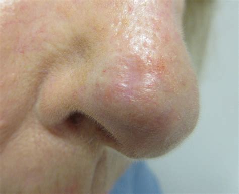 skin cancer types  nose