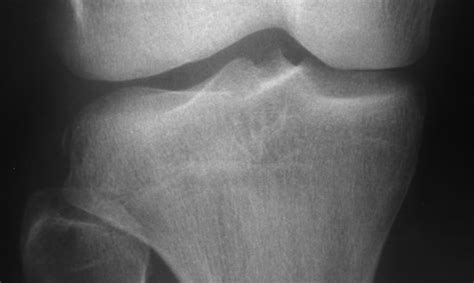 Daily Dose: Segond fracture