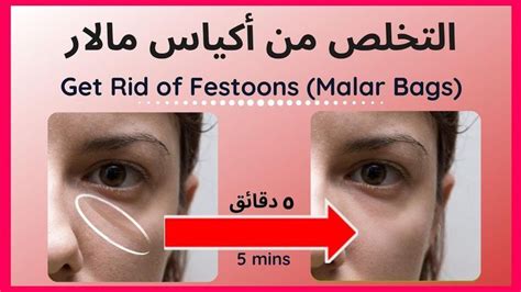 Malar Bags Vorher Nachher