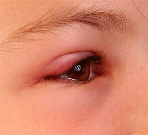 Swollen Eyelid - Symptoms, Treatment, Pictures, Causes | HealDove