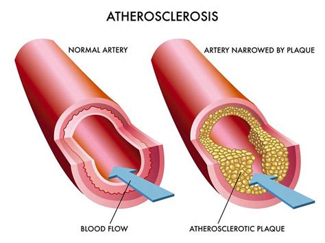 Clogged Arteries - Causes, Symptoms, Signs, Treatment and Prevention