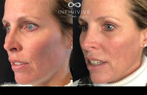 Yeso Therapy Before And After