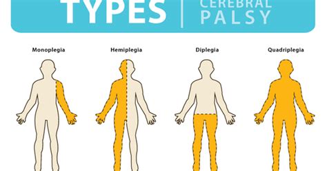 Hemiparesia E Hemiplegia - stimr.com: Hemiplegia & the OT role