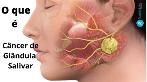 Cancer Na Glandula Salivar Tem Cura