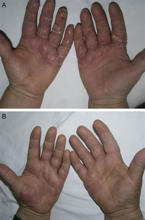 Effectiveness and Safety of Psoralen-UVA (PUVA) Topical Therapy in