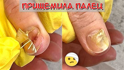 Прищемила палец дверью / Сошел ноготь на руке, что делать? - YouTube