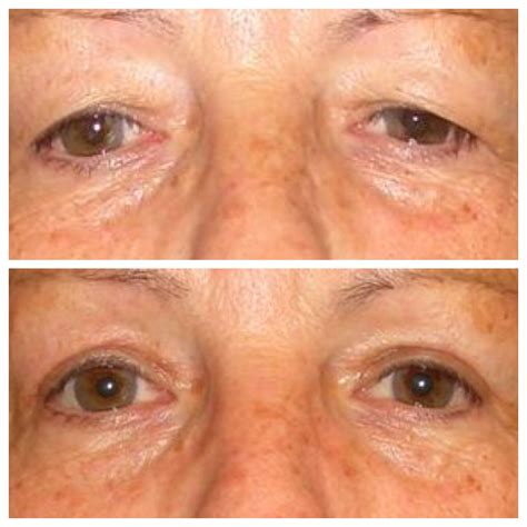 BLEPHAROPLASTIK 2 | www.augenmedizin.at