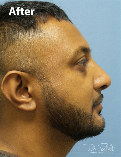 Chin Implant 3 - Dr. Schalit Cosmetic Facial Specialist