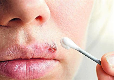 Why do we get cold sores and how can we treat them? | Sur in English