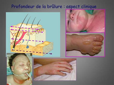 PPT - Les brûlures: prise en charge chirurgicale PowerPoint
