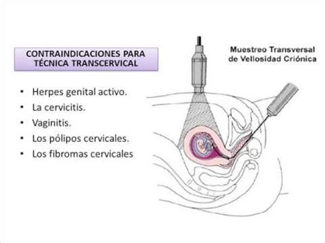 AMNIOINFUSIÓN - YouTube