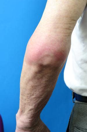 angsana tree gout attack explained