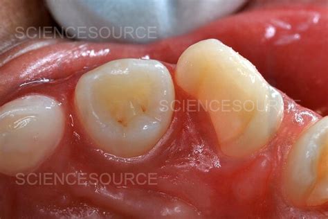 Photograph | Dens in Dente Malformation | Science Source Images