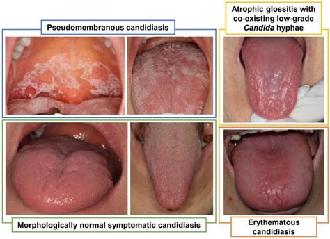 Clinical Characteristics and Relevance of Oral Candida Biofilm in