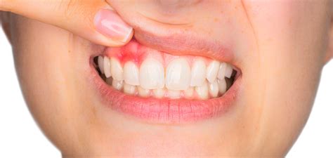 Ientulehduksen hoito - Vinkit ja neuvot | pepsodent