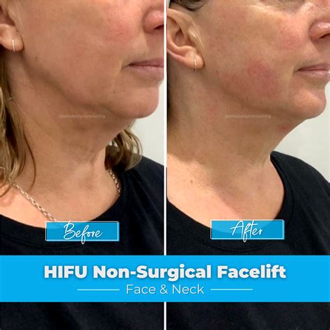 face lift non invasive 4