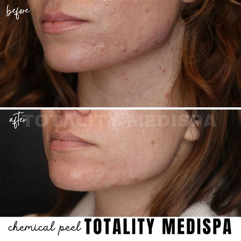 chemical peel    patient  totality medispa