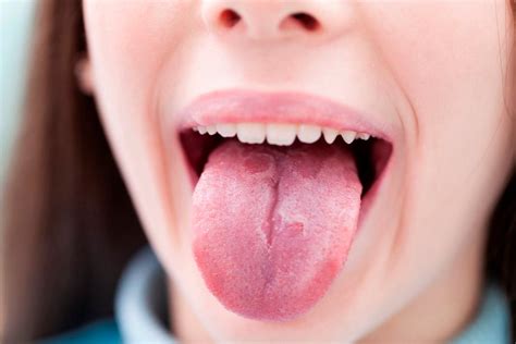 Lingua Cheia De Aftas - Aftas en la lengua: causas, síntomas y tratamientos efectivos - MIO