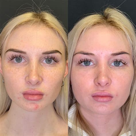 Unbelievable Blackhead Removal 2024: My Honest Review & Before/After Pics. Image 15