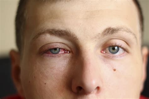 Eyebrow Swelling at Pamela Denson blog