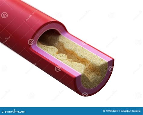 blocked artery stock illustration cartoondealercom