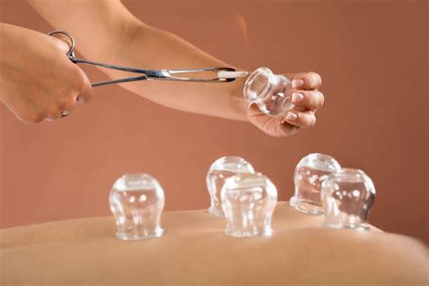 cupping therapy   health clinic farringdon