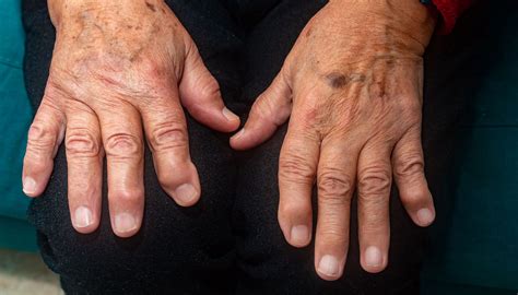 heberdens nodes surgery