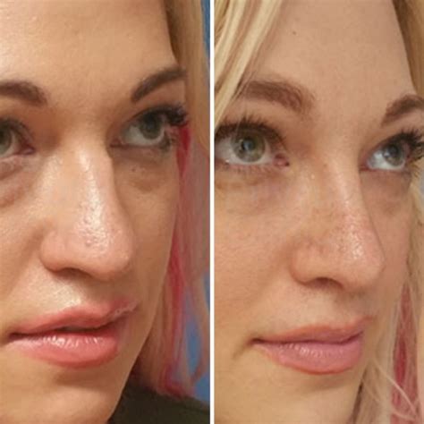 Finance Nose Surgery