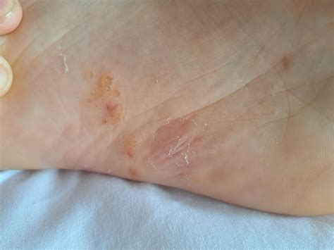 Hi all :) this is the bottom of my foot. Been and endless cycle for