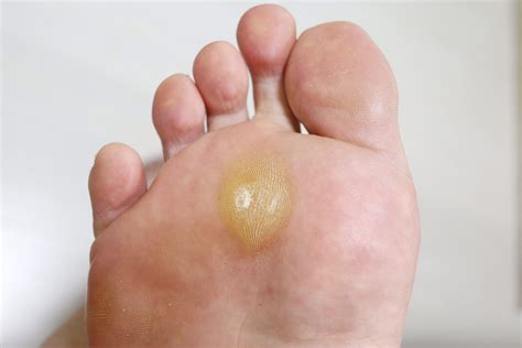Corns and Callus - Cutting Edge Podiatry