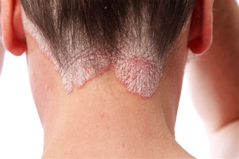 Psoriasis of the Scalp