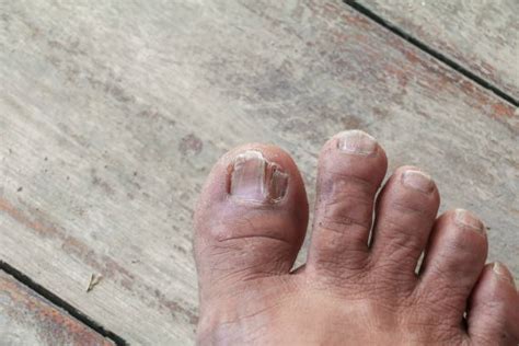 Curved Toenails Stock Photos, Pictures & Royalty-Free Images - iStock