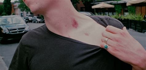 Science Explains How a Hickey Can Kill You