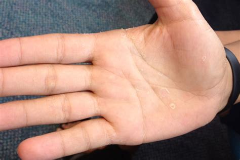 Pitted Keratolysis Hands