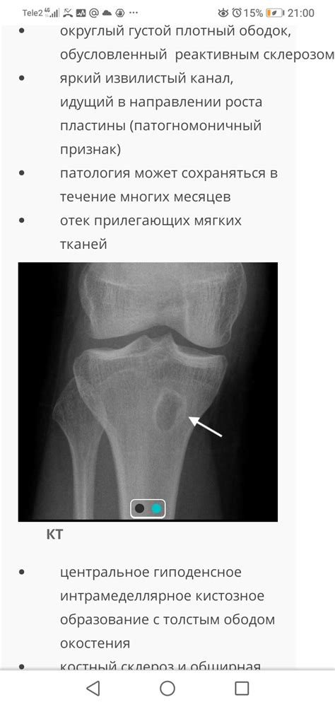 Абсцесс Броди? | Портал радиологов