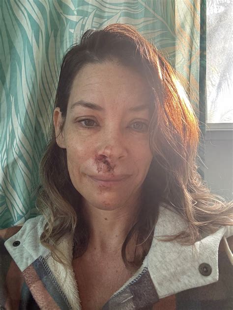 Evangeline Lilly Shares Photos of Facial Injuries After Beach Fall | Us