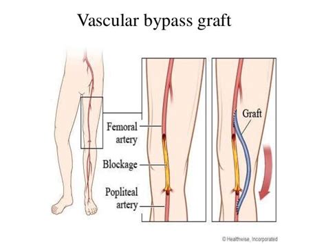 Peripheral vascular disease