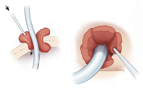 Cochlear Implant Surgical Variations – Oto Surgery Atlas