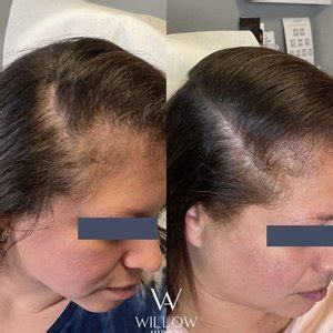 How to Restore Thin Hair and a Receding Hairline