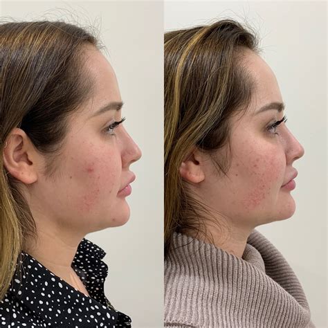 kybella honest review     bboggg