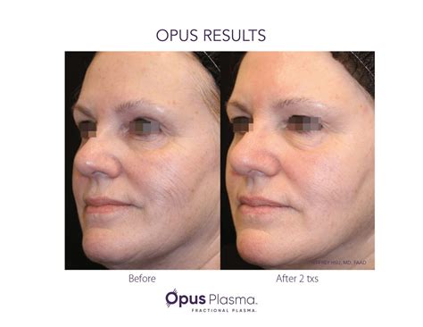 Facial Skin Resurfacing | Opus Plasma