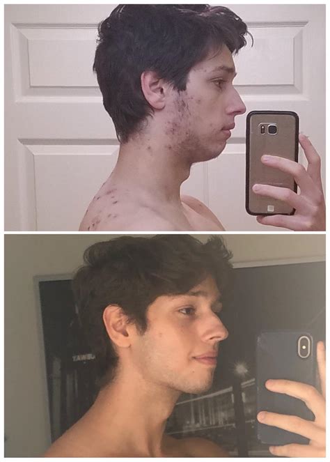[Selfie] 2 year transformation and glow up. Cystic acne really fucked ...
